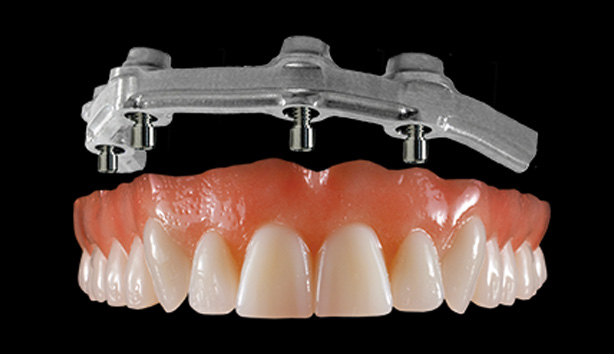 Implant Hybrid Denture